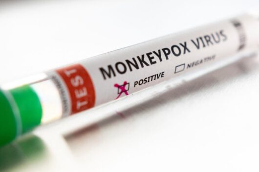 Грција го регистрира првиот случај на мајмунска сипаница